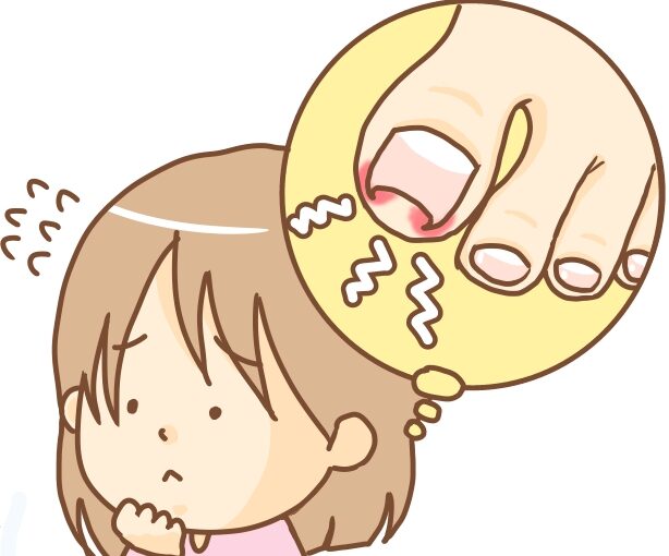 神奈川県　巻き爪　女性